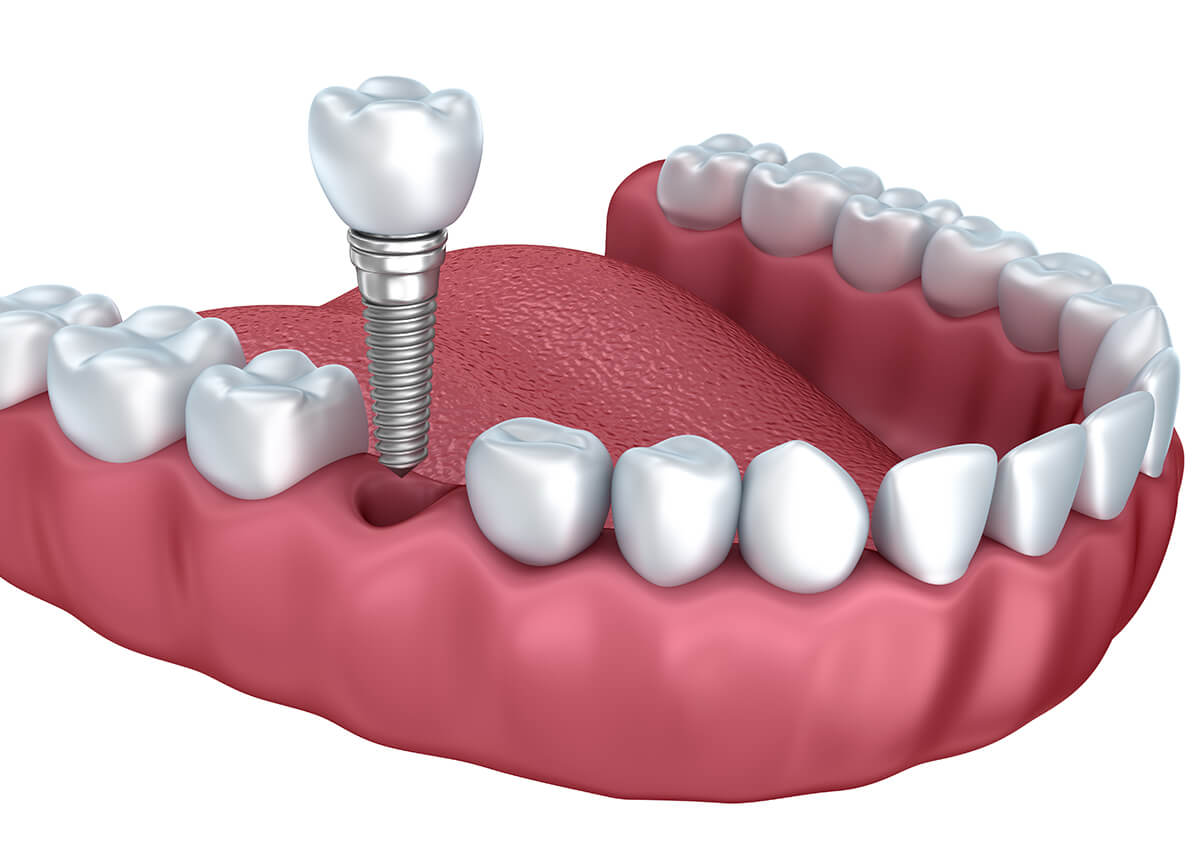 Dental Implant Surgery in Edmonds WA Area