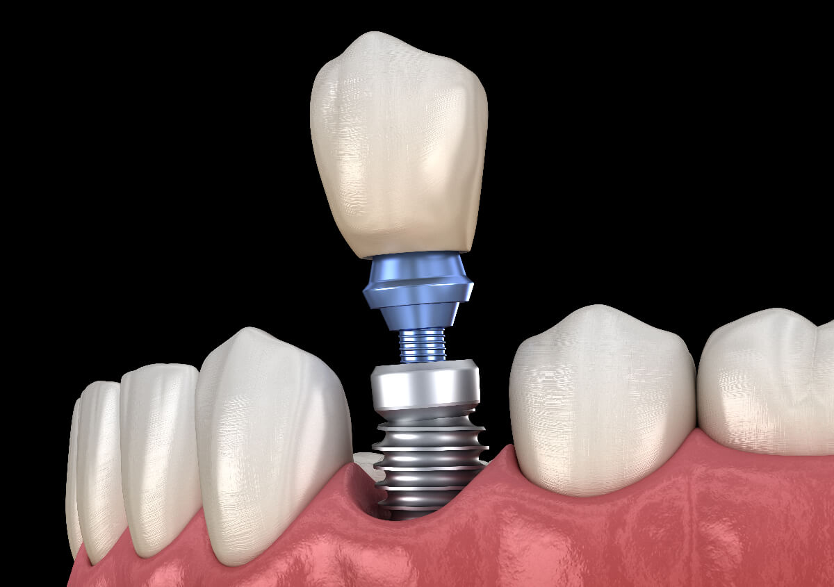Relieve Dental Implant Pain in Edmonds WA area